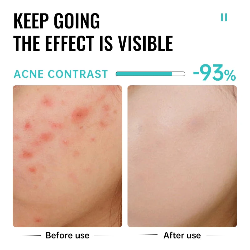 Salicylic Acid Acne Treatment Cream Repair Pimple Spots Deep Cleaning Pore Shrinking Anti-acne Oil Control Moisturizer Skin Care