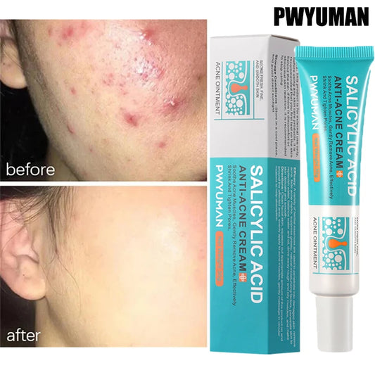 Salicylic Acid Acne Treatment Cream Repair Pimple Spots Deep Cleaning Pore Shrinking Anti-acne Oil Control Moisturizer Skin Care